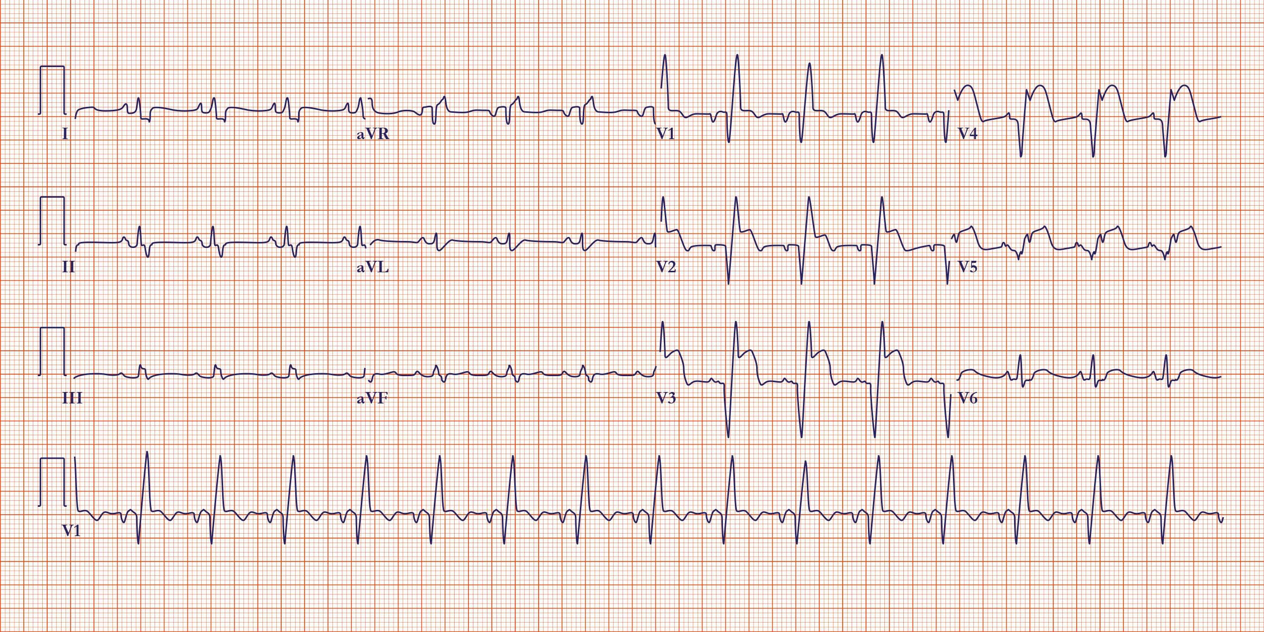 Sythentic ECG image