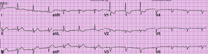 Sythentic ECG image