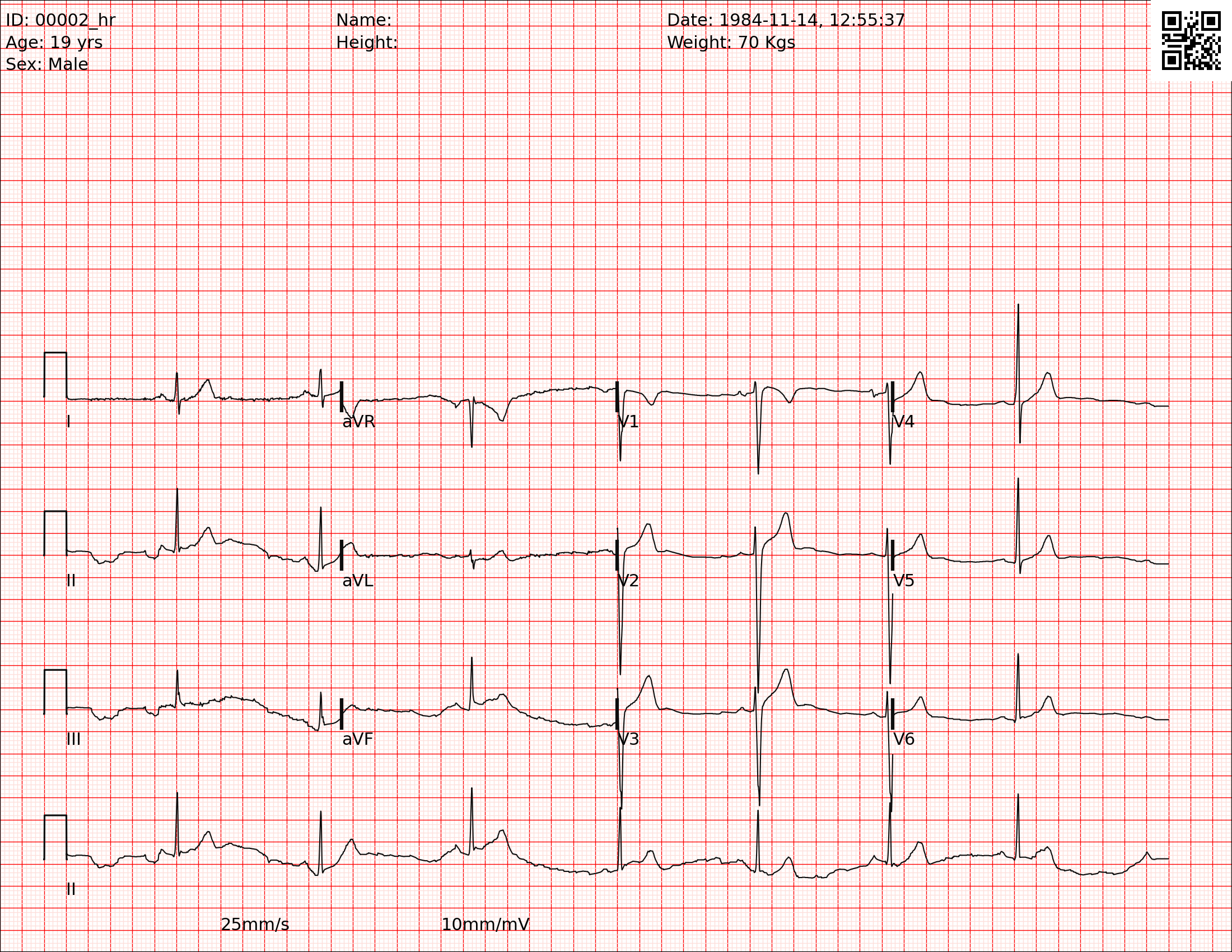 Sythentic ECG image