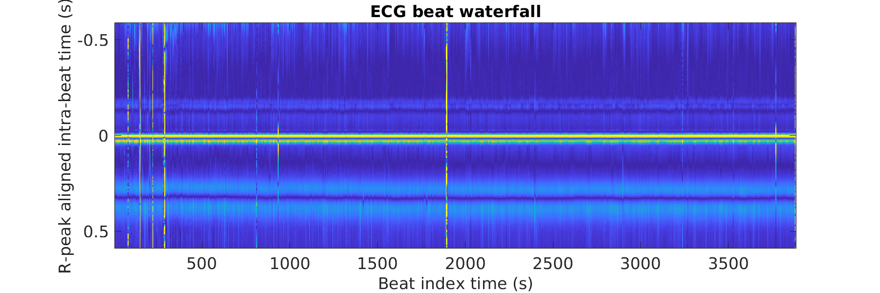 P015_ecg_beats_waterfall