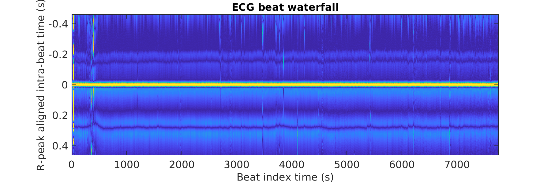 S003_ecg_beats_waterfall