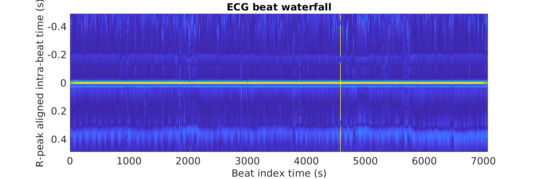 S011_ecg_beats_waterfall