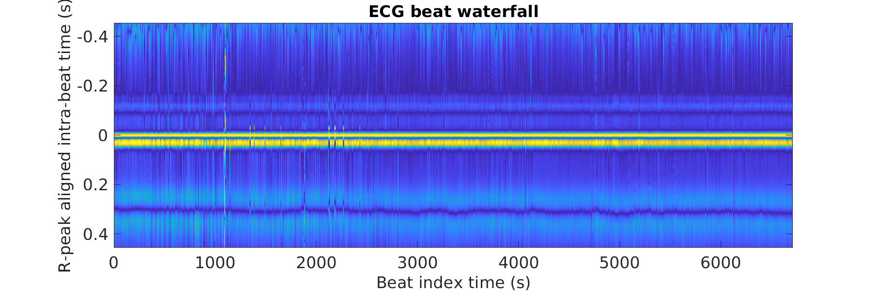 S014_ecg_beats_waterfall