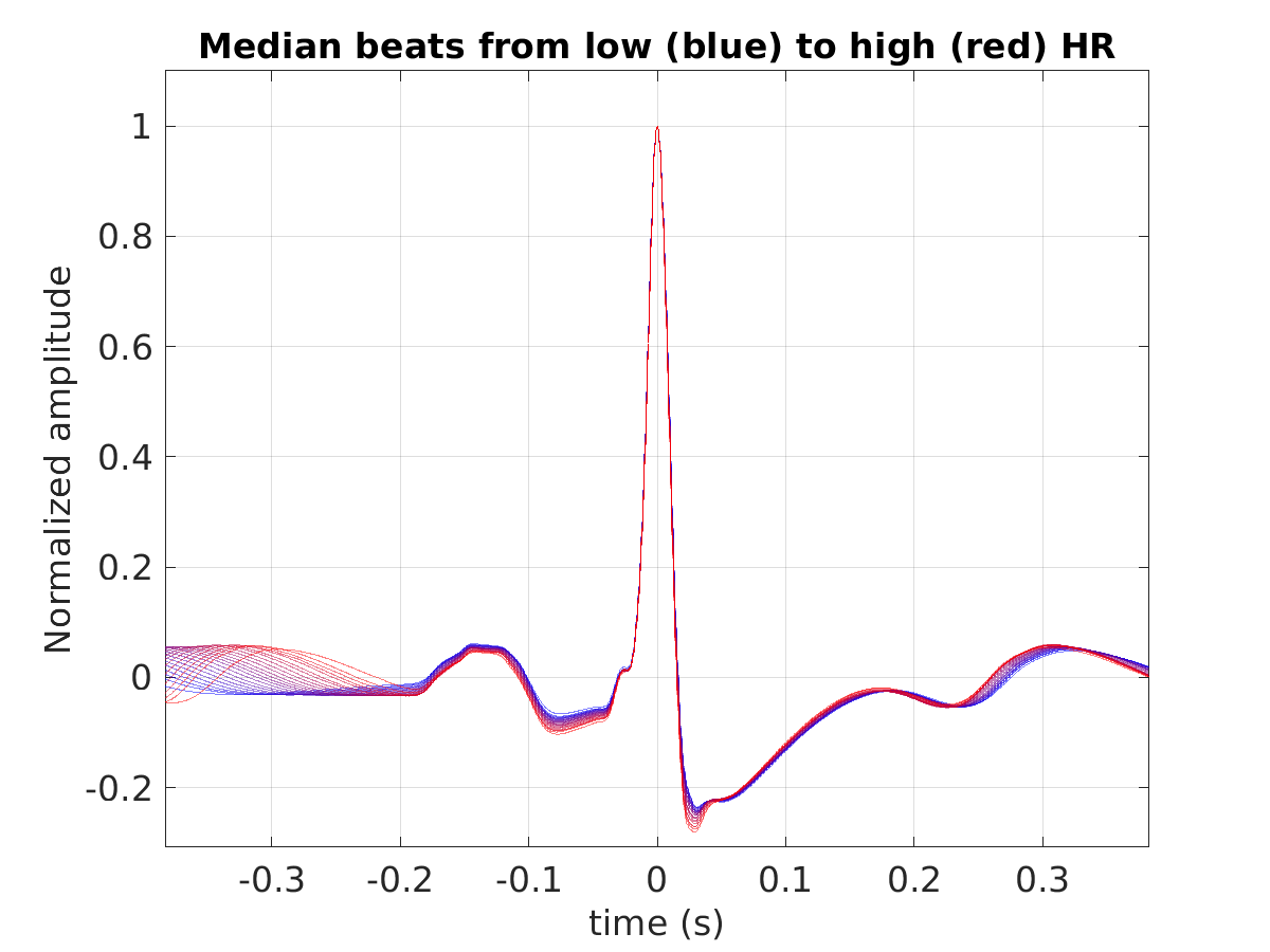 S025_ecg_med_beats_hr_binned