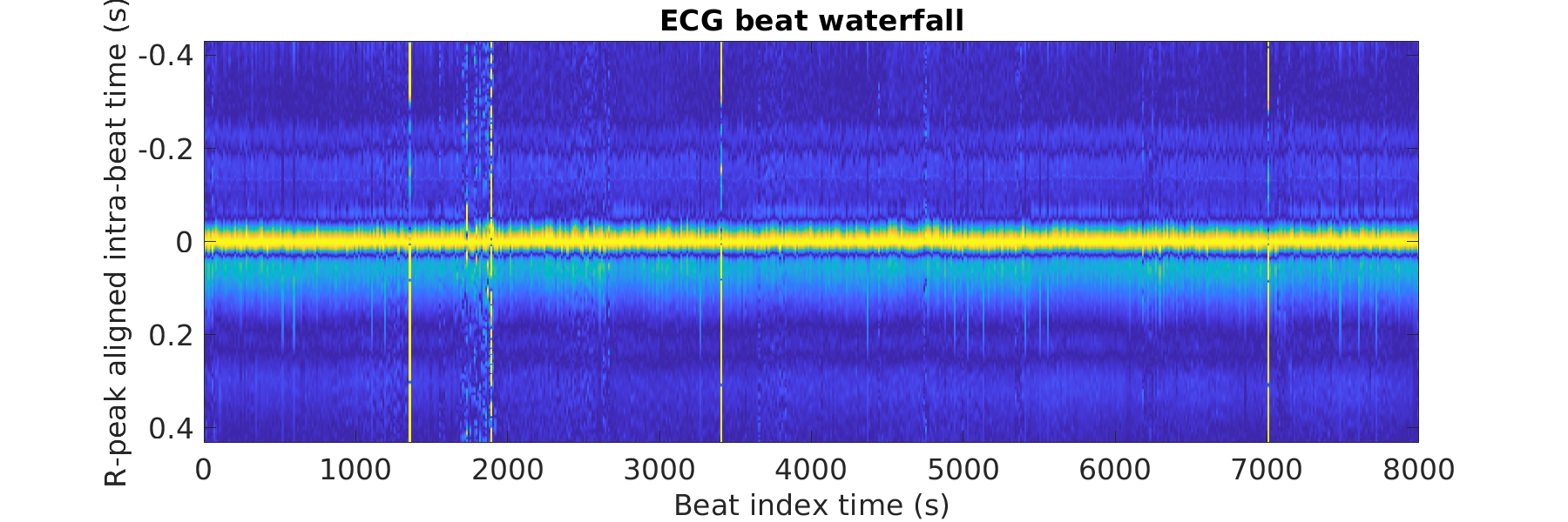 S029_ecg_beats_waterfall