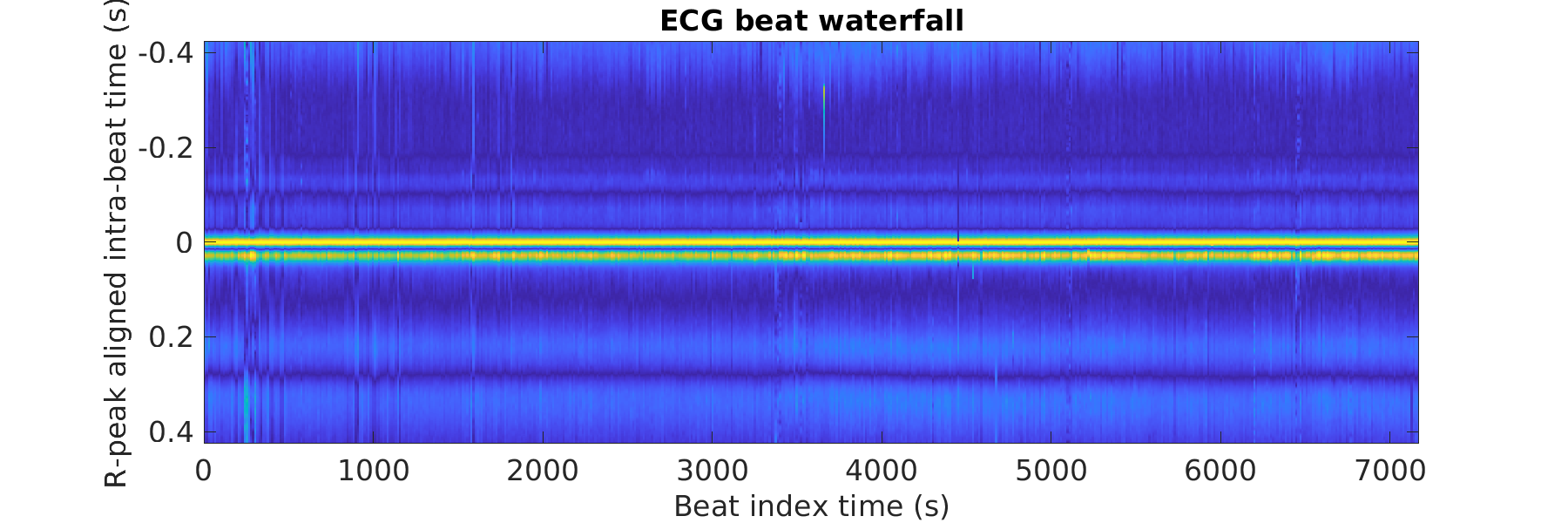 S040_ecg_beats_waterfall